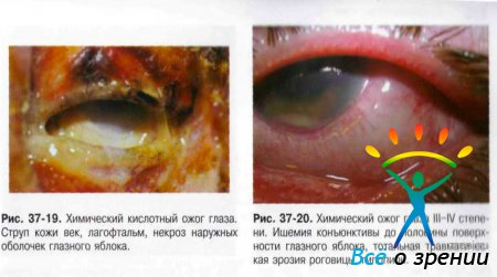 Мкб 10 ожог слизистой глаза