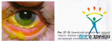 Мкб 10 ожог слизистой глаза