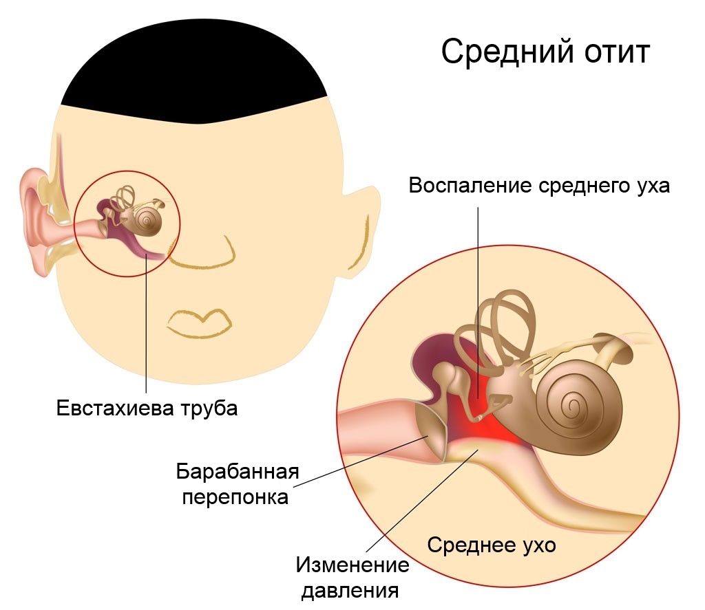 Средний отит