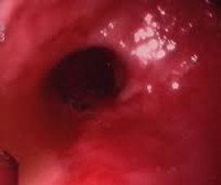 Ожог пищевода