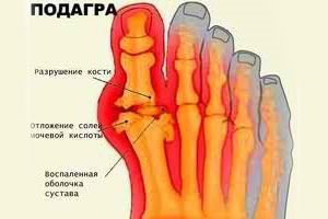 Подагра ног Подагра ног