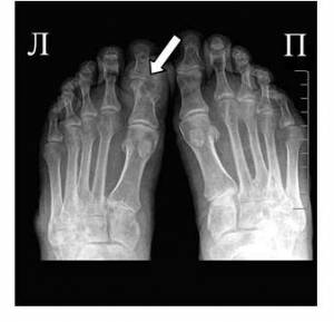 Подагра ног Подагра ног