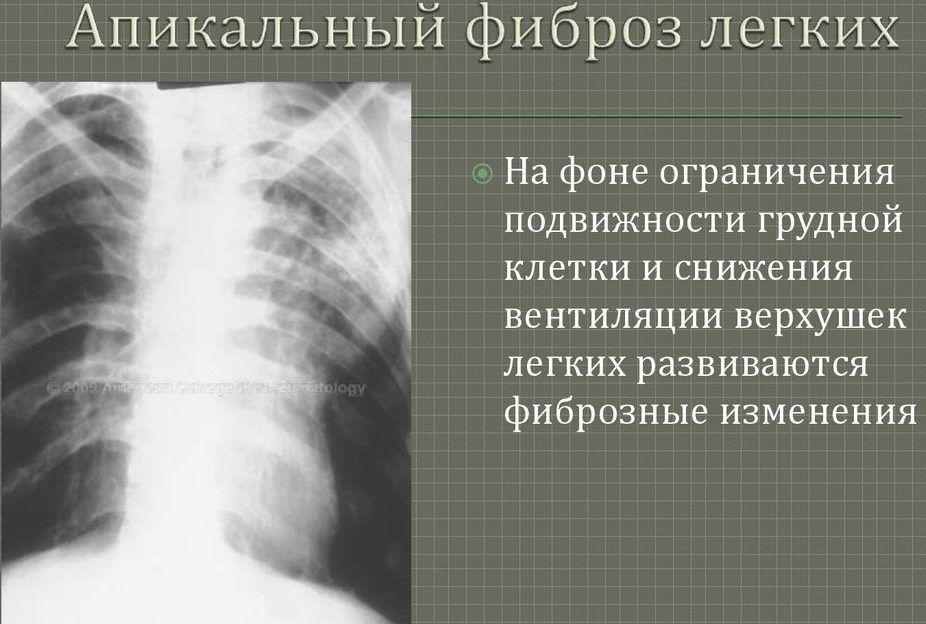 Фиброз