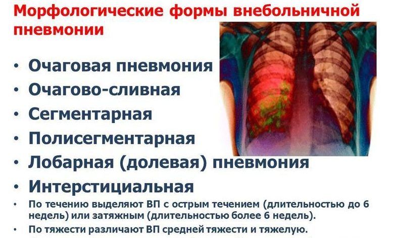 Формы пневмонии