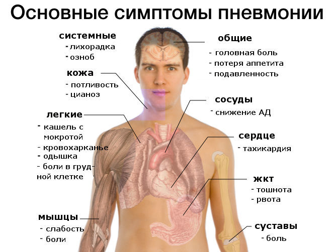 Где появляются болевые ощущения при пневмонии