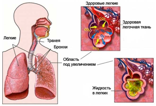 Отек легких и пневмония у пожилых людей
