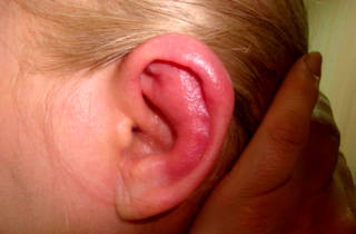 Перихондрит - воспаление уха Воспаление уха