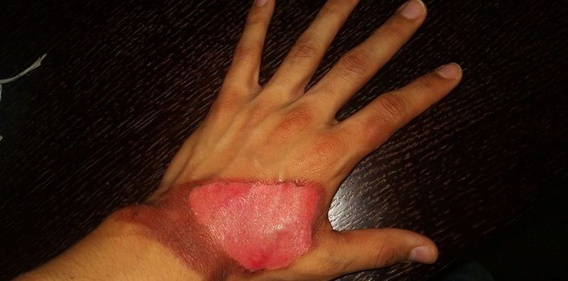 Ожог кожи от сварки