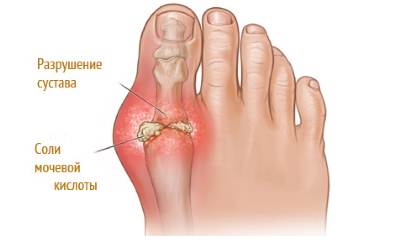 Подагра на пальце ноги