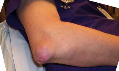 Подагра на руках