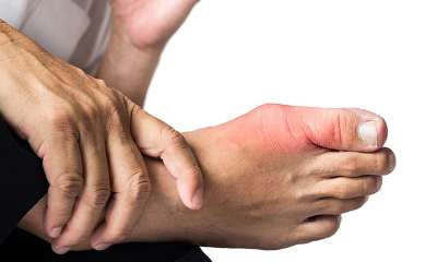 Признаки подагры