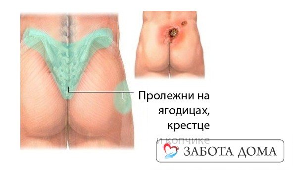 Пролежни на ягодицах Пролежни на ягодицах