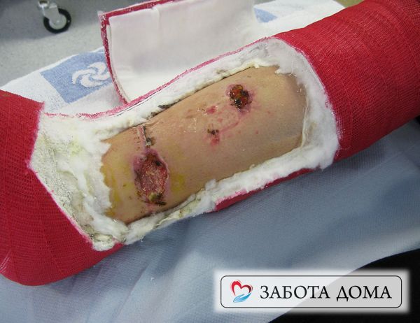 При наложении гипсовой повязки оставляют небольшое «окошко», просвет в гипсе, чтобы можно было производить осмотр и обработку открытой раны. Окно для раны в гипсе