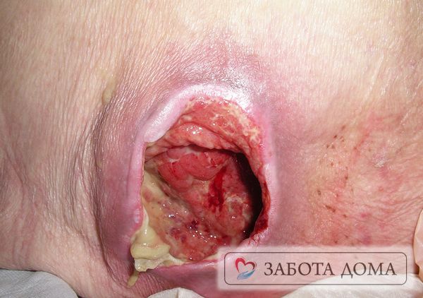 Гнойные пролежни Гнойные пролежни