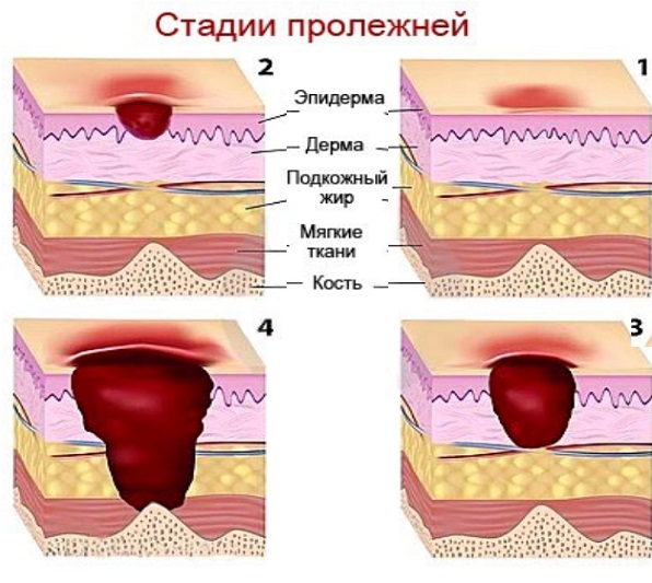 Эффективное лечение пролежней у пожилых людей