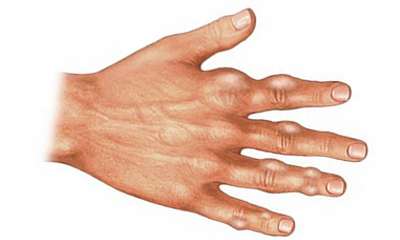 Тофусы при подагре