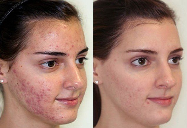 Девушка с проблемной кожей