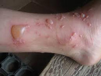 Ожоги у детей Ожоги у детей