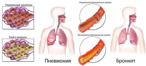 Проявление температуры и кашля у взрослых при пневмонии. А может ли воспаление легких протекать без них?
