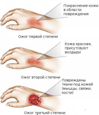 Степени ожогов