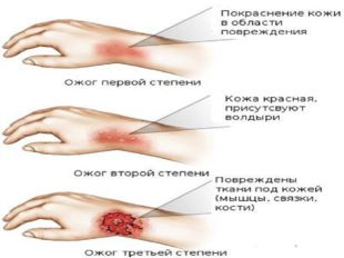 Первая помощь при ожогах и обморожениях презентация скачать бесплатно