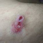 Как быстро вылечить пролежень на бедре Как быстро вылечить пролежень на бедре