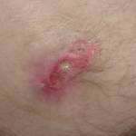 Как быстро вылечить пролежень на бедре Как быстро вылечить пролежень на бедре