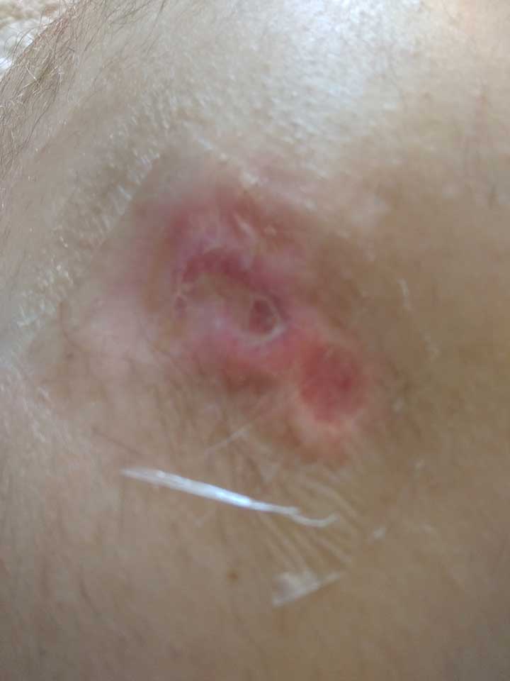 Как быстро вылечить пролежень на бедре