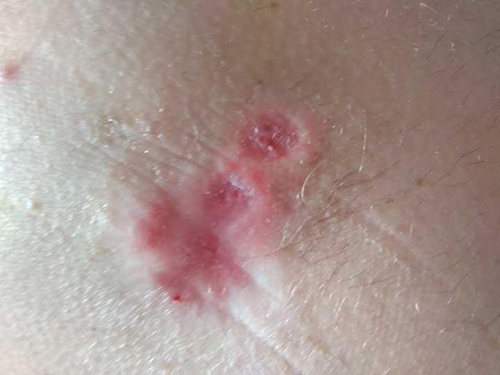 Как быстро вылечить пролежень на бедре