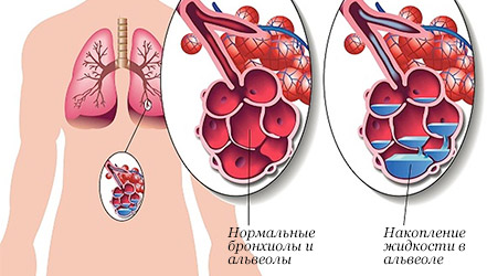 Воспаление легких