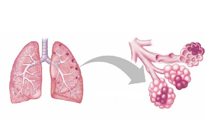 Мелкие очаги
