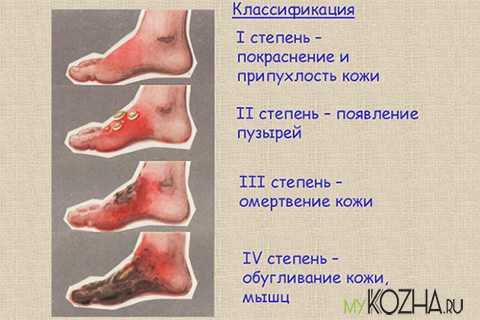 классификация ожогов