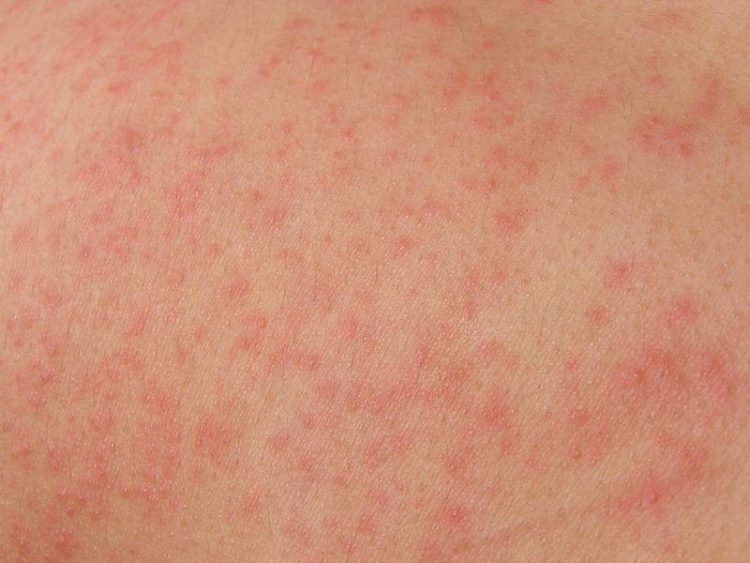 У ребенка высыпания похожие на ожоги