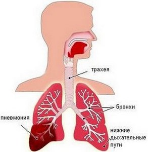 Крупозная пневмония Крупозная пневмония