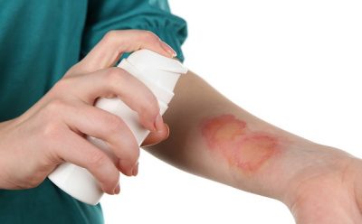 Ожог белый пузырь как лечить