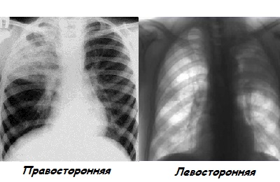 Поражение доли
