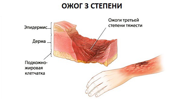ожог 3 степени ожог 3 степени