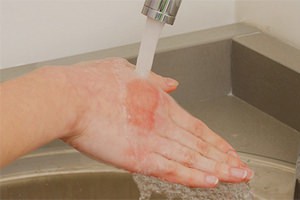 Что делать при ожоге кипятком Что делать при ожоге кипятком