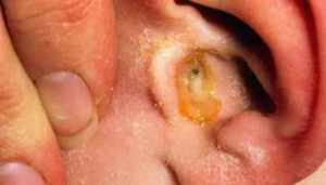 Наружный отит Как лечить наружный отит