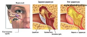 Отит уха Лечение отита уха