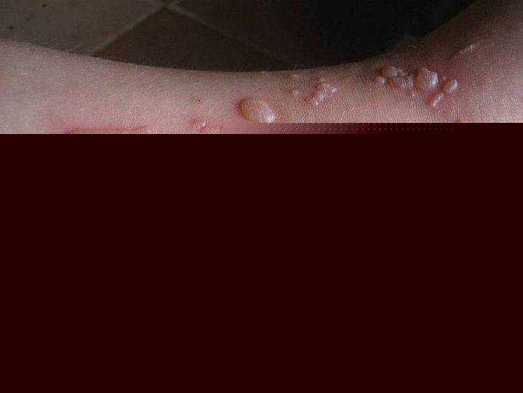 Ожог белый пузырь как лечить