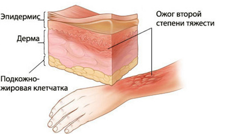 Ðжог вÑоÑой ÑÑепени