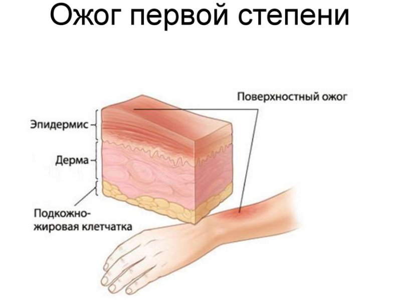 СимпÑом ожога пеÑвой ÑÑепени