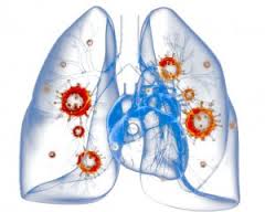 симптомы пневмонии
