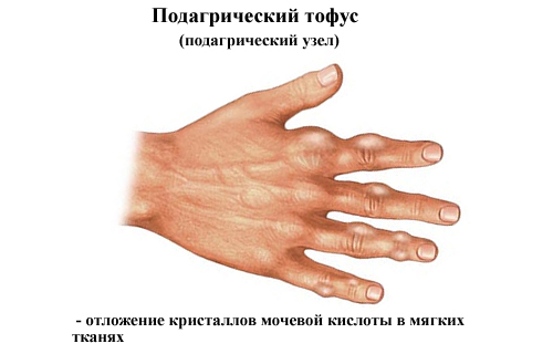 Подагрические тофусы Подагрические тофусы