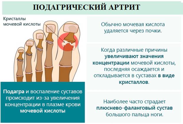 Подагрический артрит Подагрический артрит