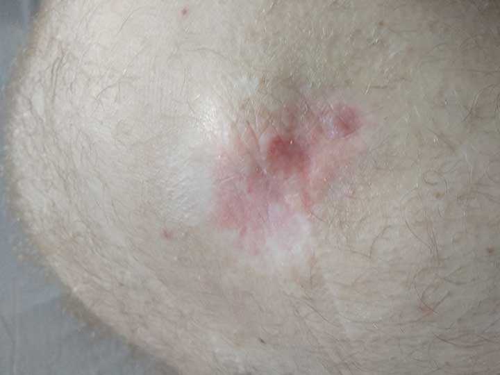 Как быстро вылечить пролежень на бедре