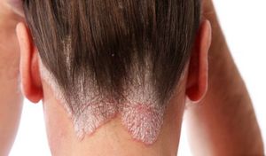 Ожог кожи при покраске волос