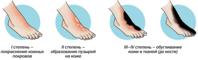 Ожоги кипятком лечение что делать с волдырями