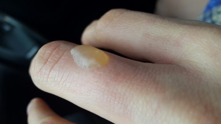 Когда сильный пузырь от ожога